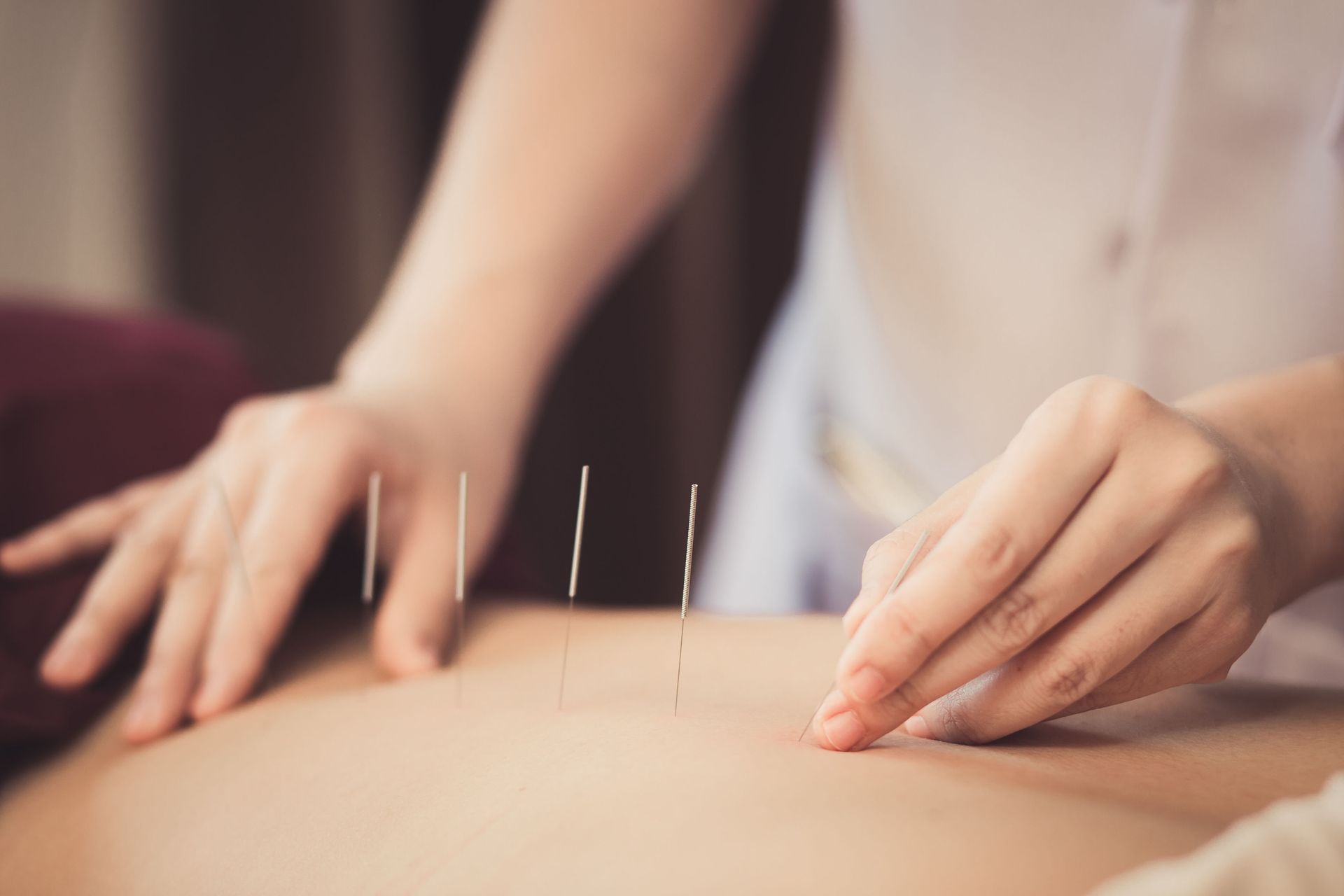 Adult male physiotherapist is doing acupuncture on the back of a female patient. Patient is lying down on a bed