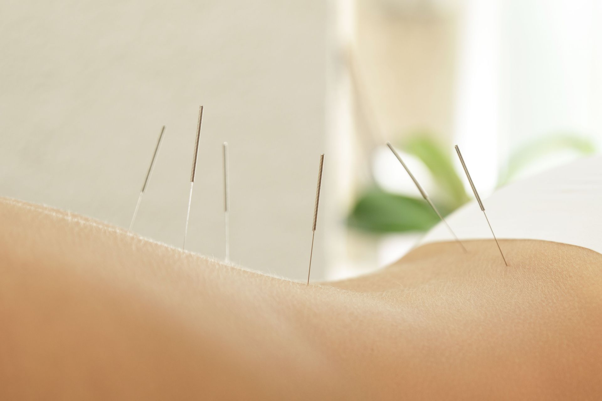 acupuncture