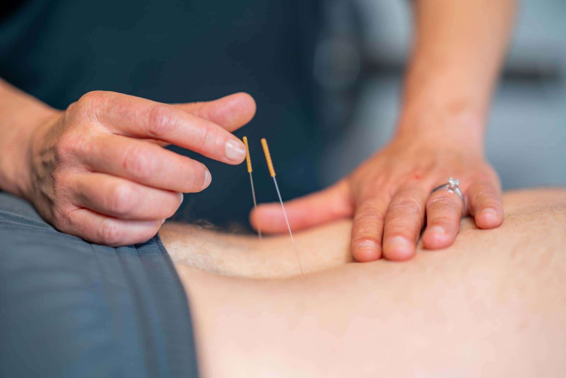 Acupuncture treatment with needles inserted into a patient’s skin, practitioner’s hands visible