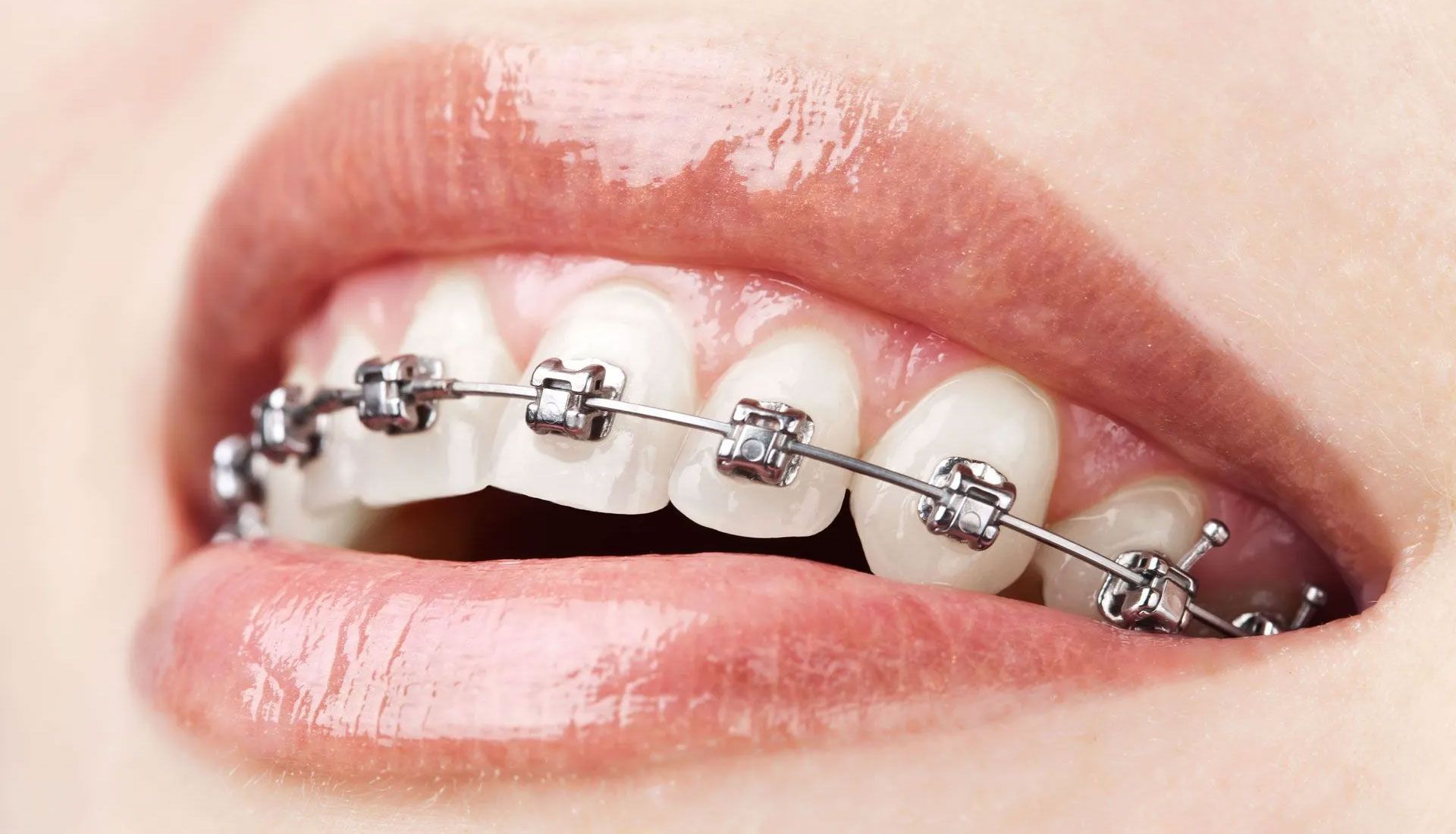 Close-up of lips with metal braces on white teeth and a slightly open smile.