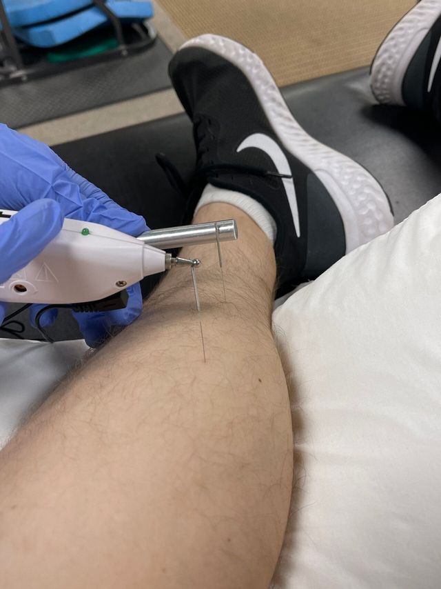 Dry Needling - 3D PT - Dallas, TX