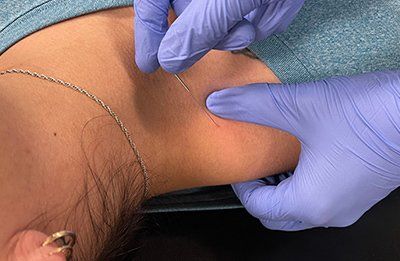 Dry needling therapy
