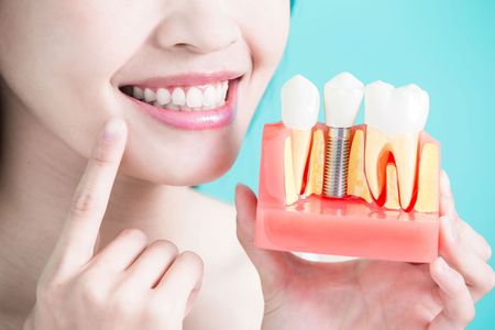 A woman is holding a model of a dental implant in her hand.