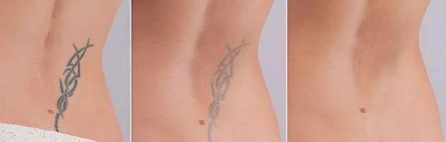 does your skin look the same after tattoo removal