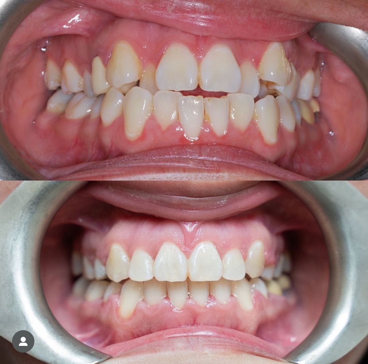 Ortho For Braces Before And After