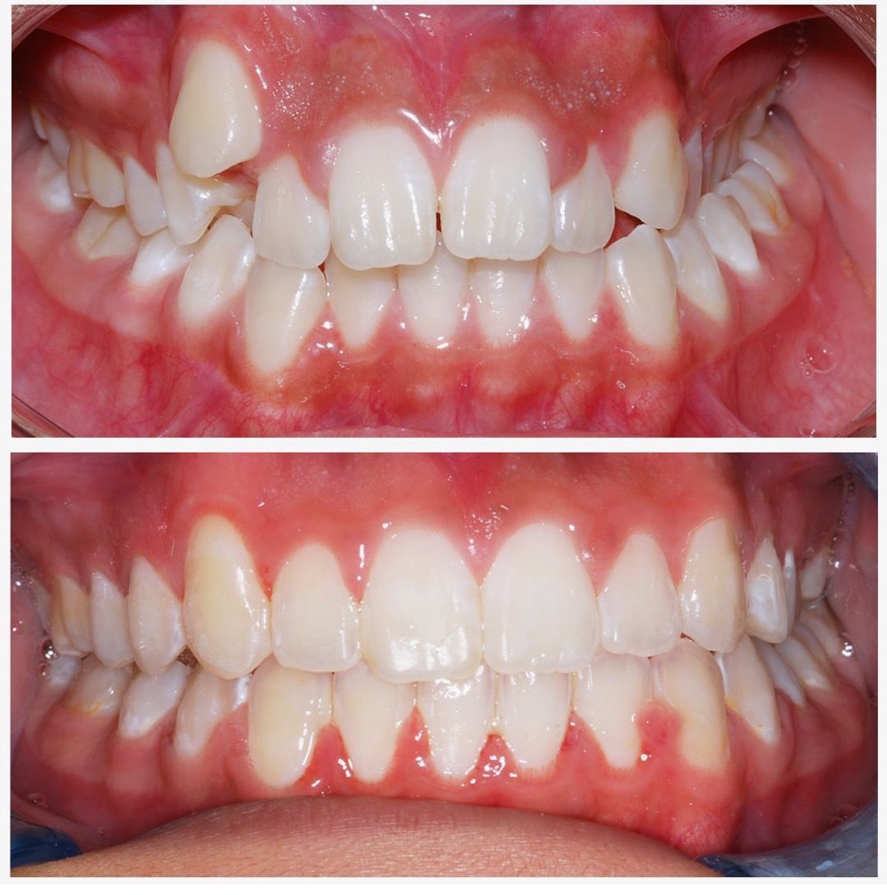 Before And After Braces