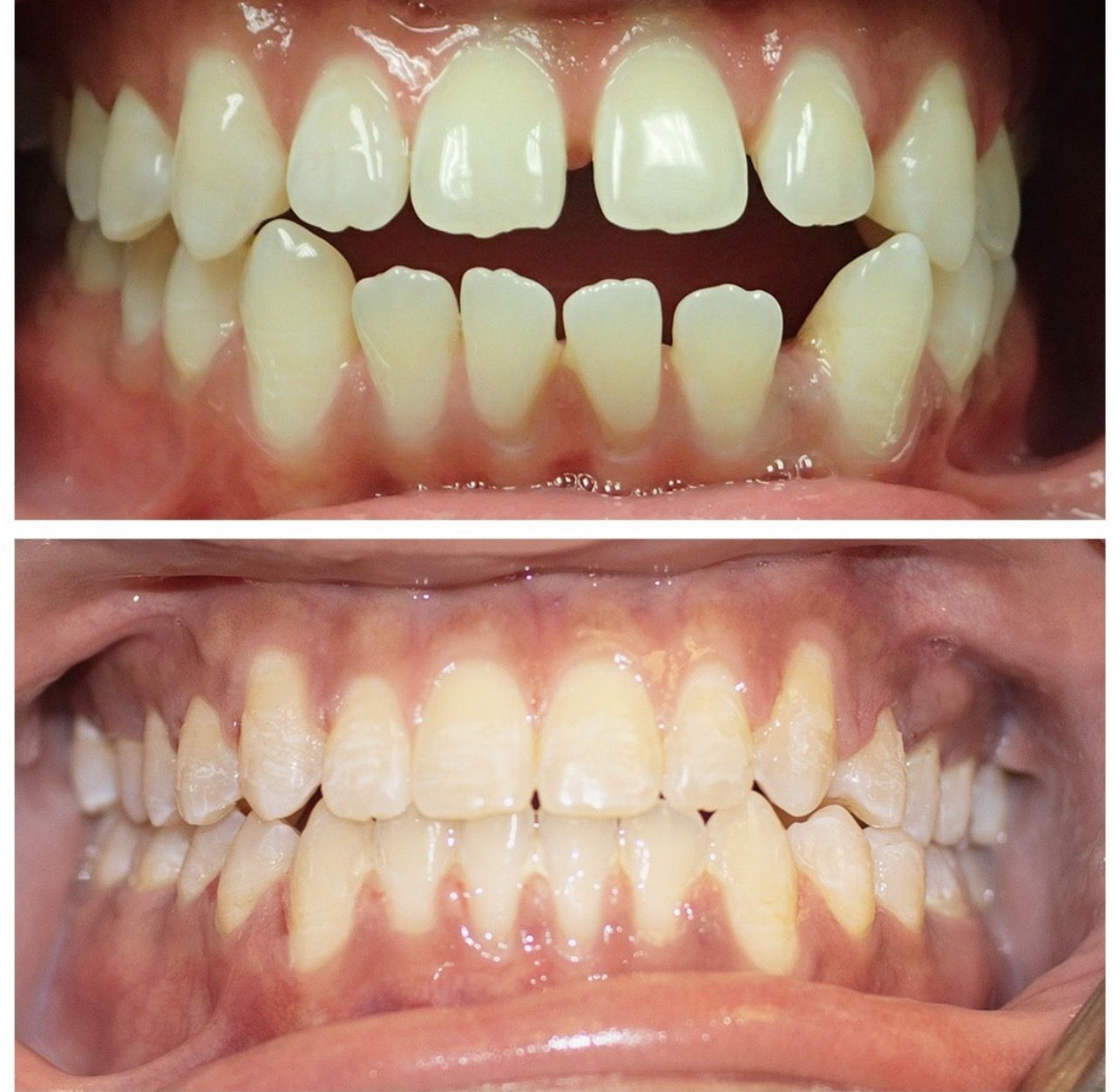 Before And After Braces