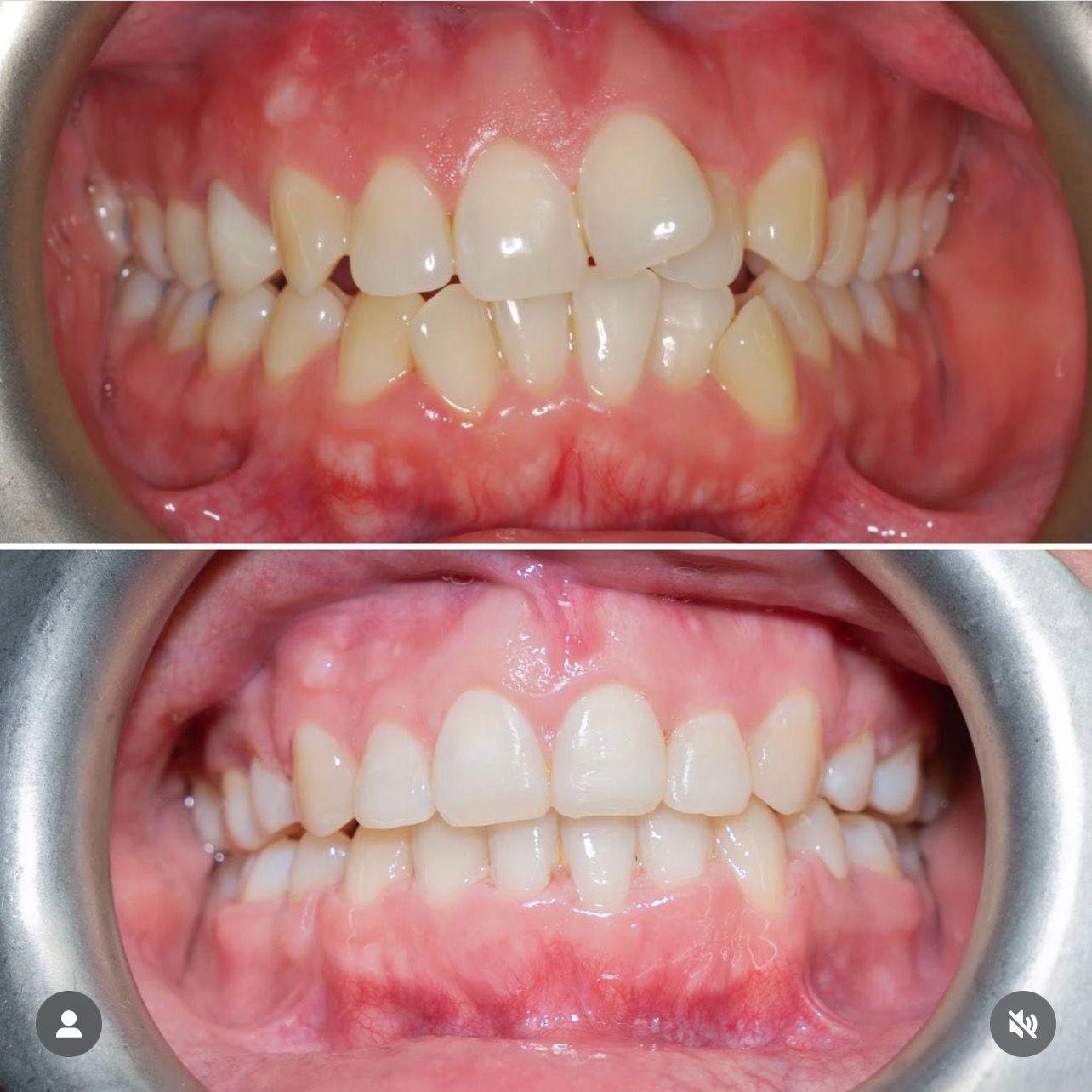 Before And After Braces