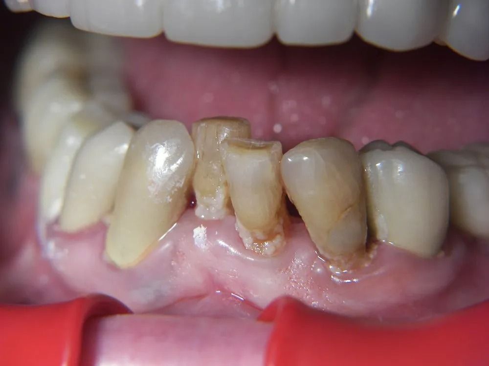 Lower Implant Case #1