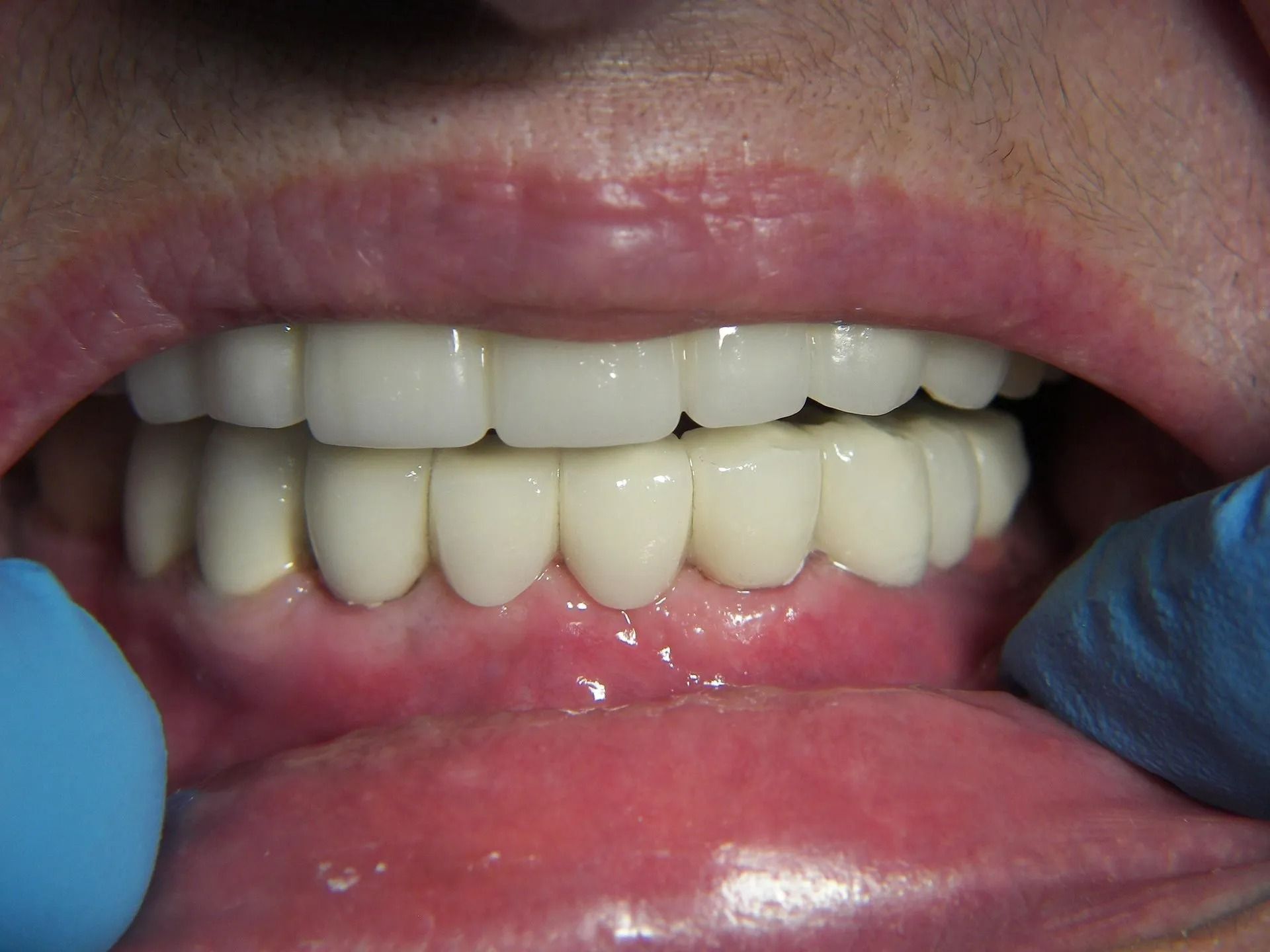 Lower Implant Case #3