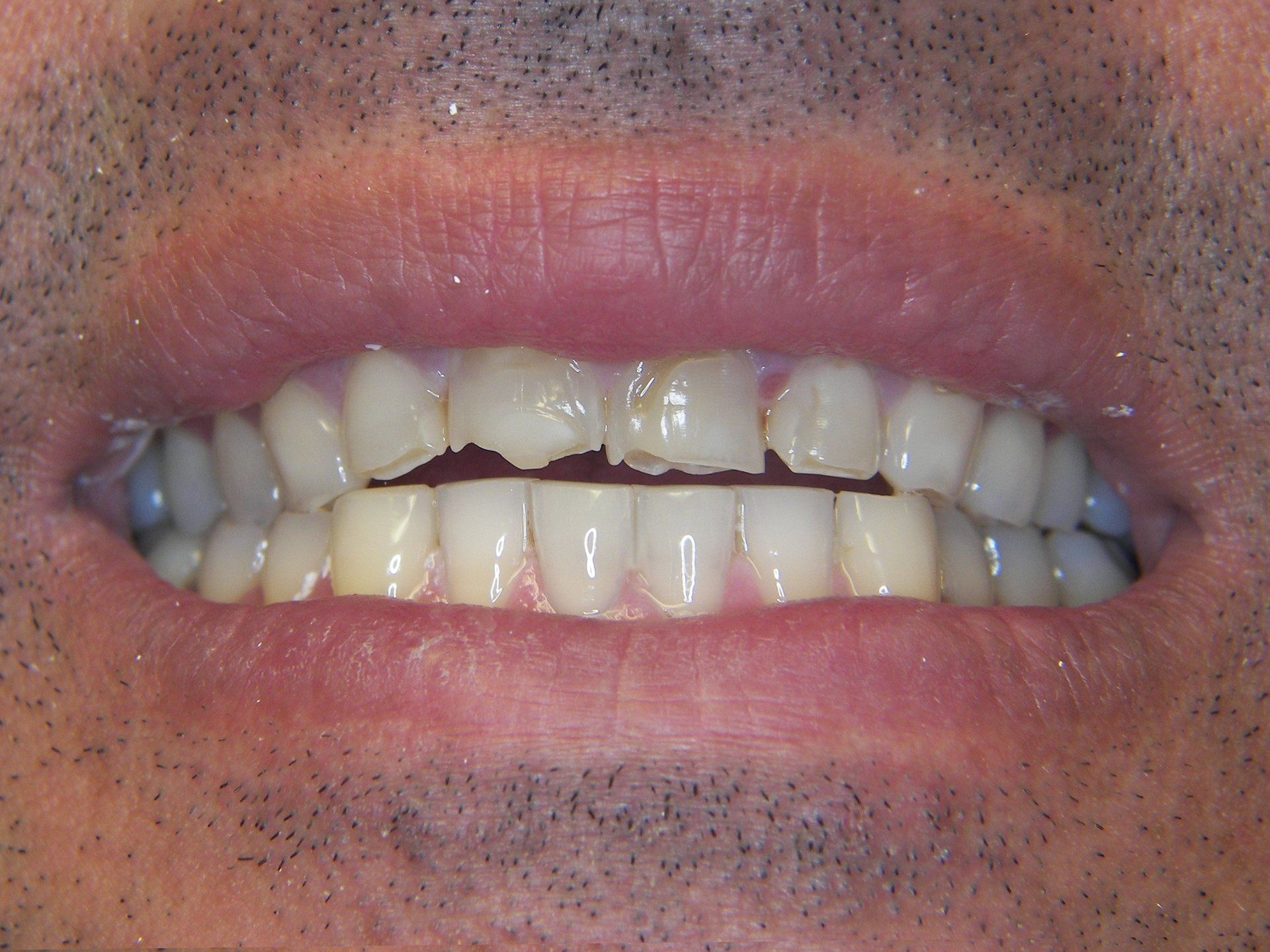 Full Maxillary Arch Reconstruction With Porcelain Crowns -before