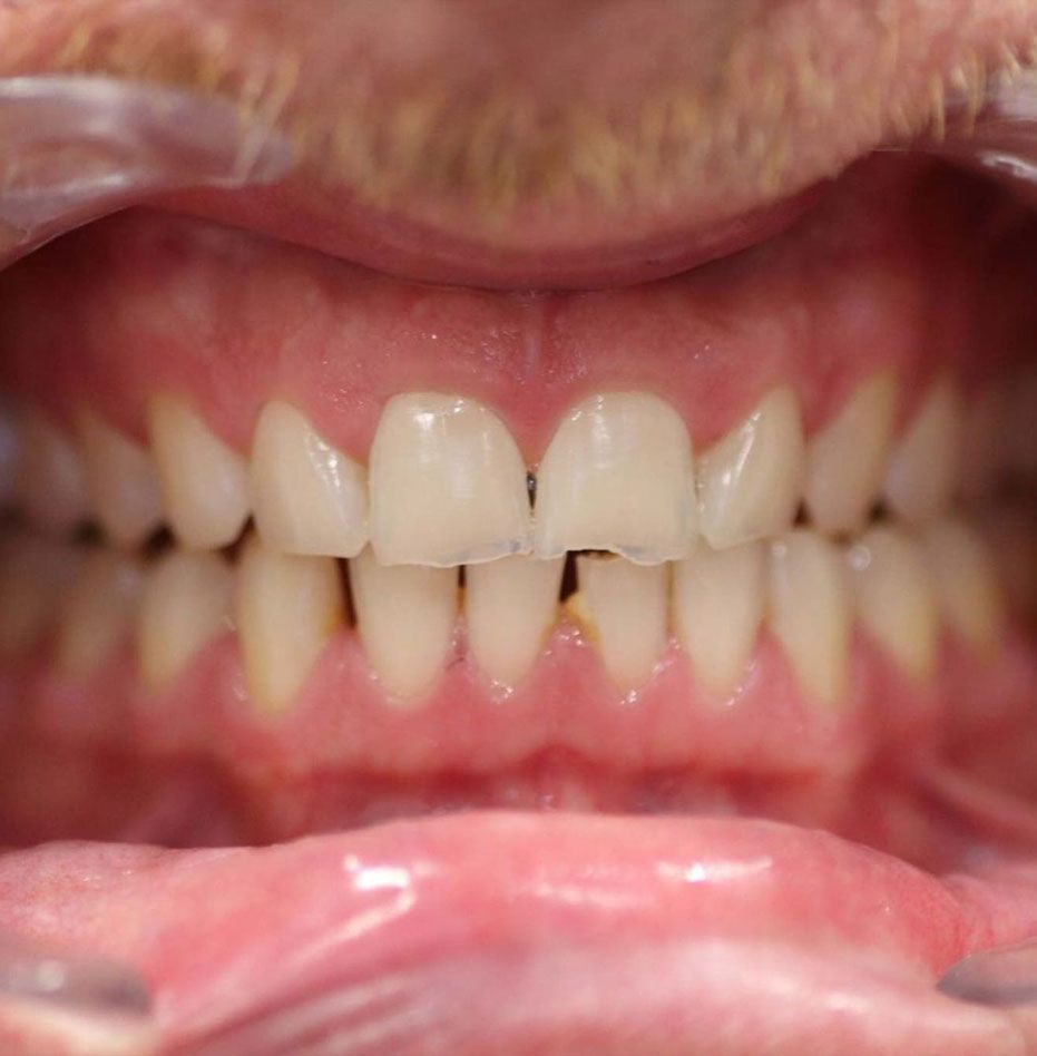 Porcelain Veneers - before