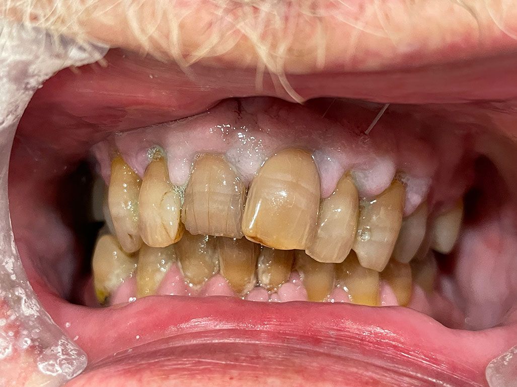 Maxillary Anterior Bridge - before