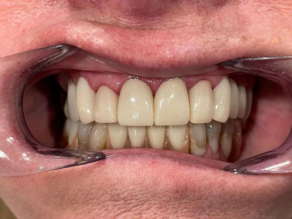 Maxillary Anterior Bridge - after