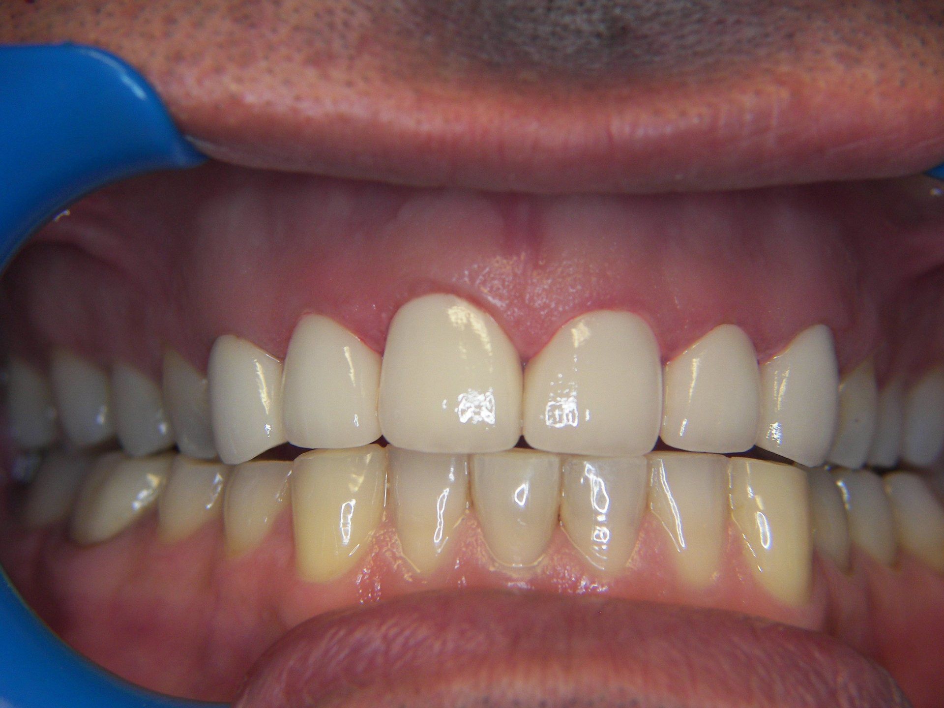 Full Maxillary Arch Reconstruction With Porcelain Crowns-after