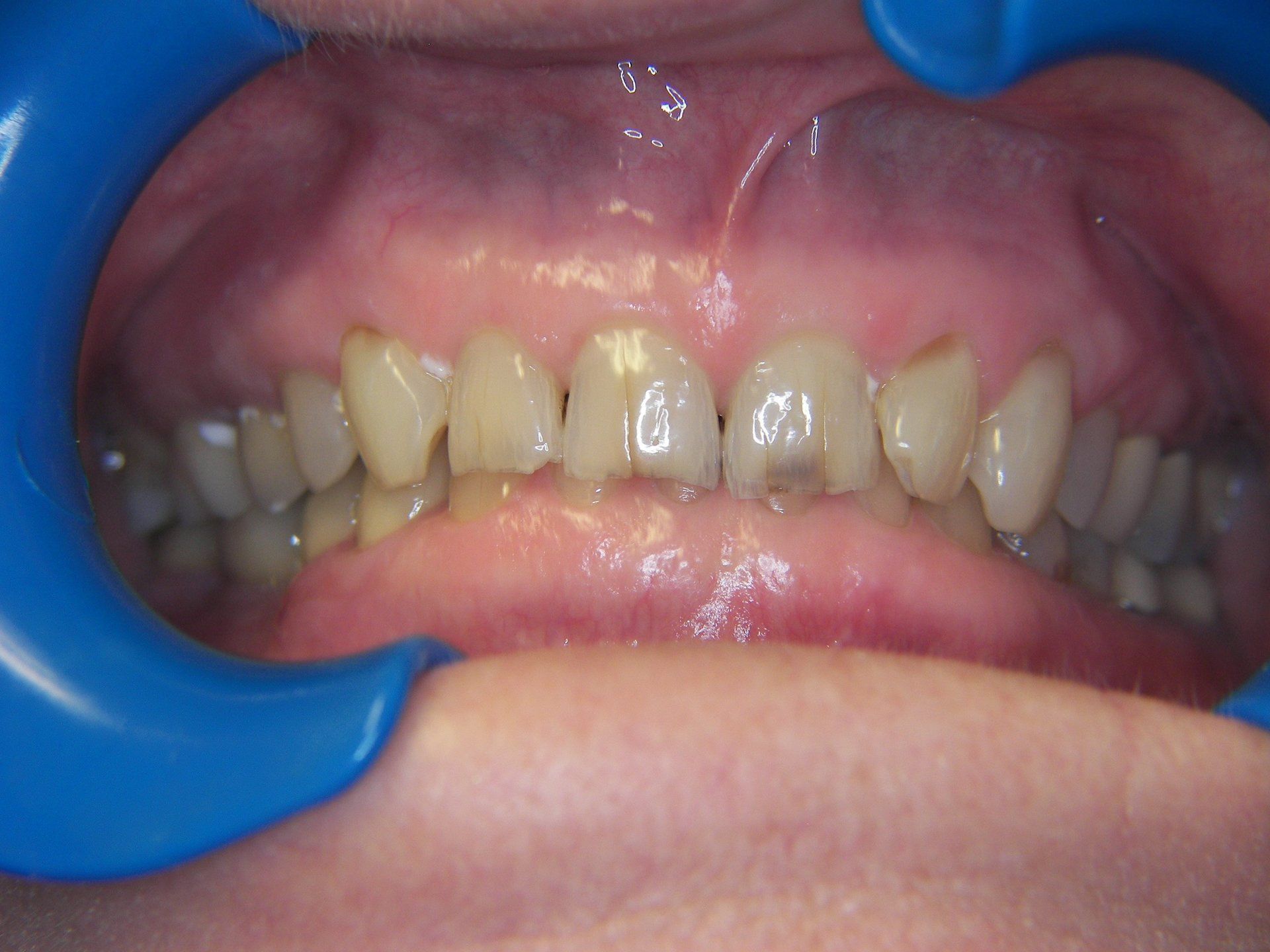 Full Maxillary Arch Reconstruction with Porcelain Crown-before