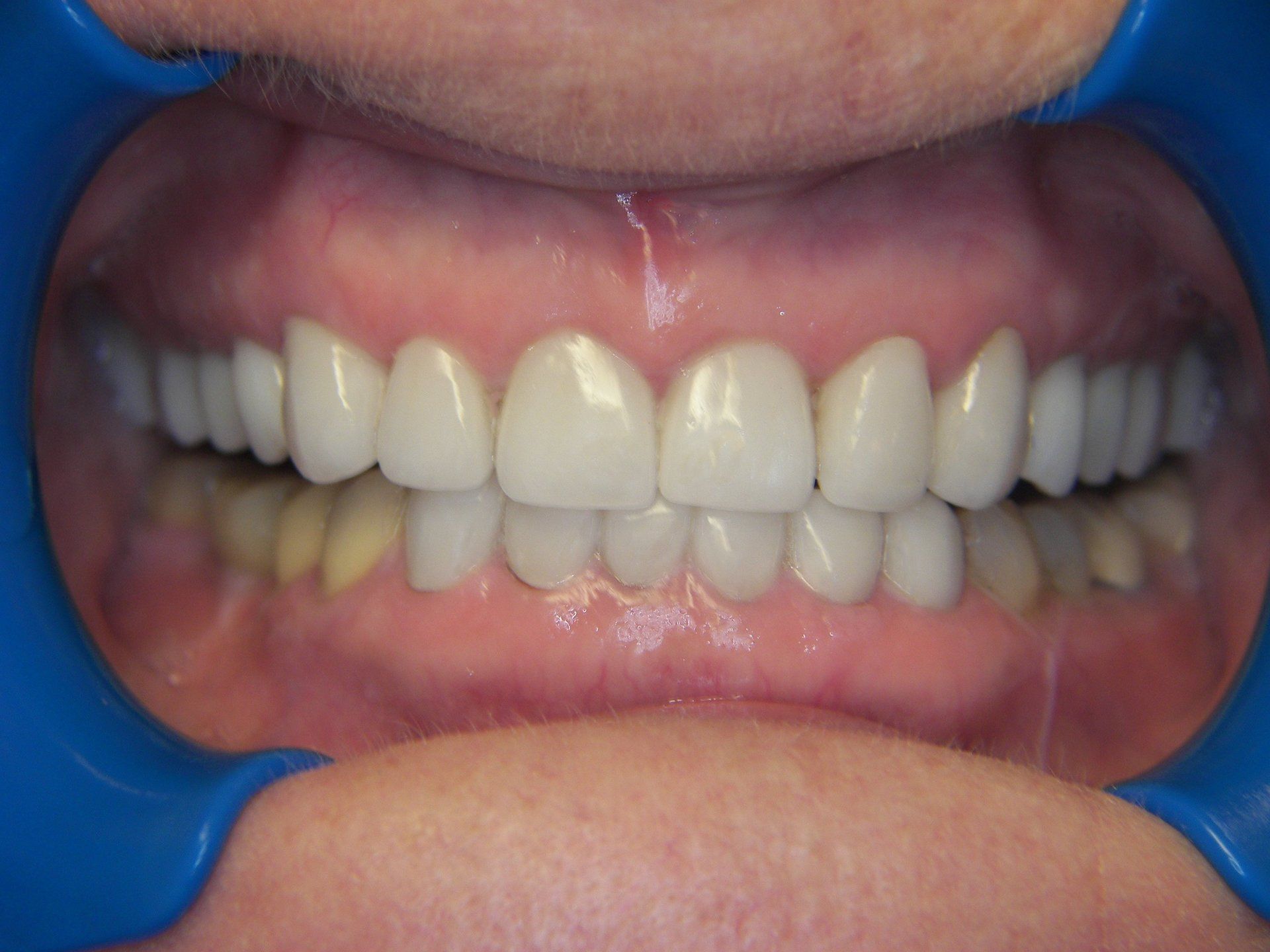 Full Maxillary Arch Reconstruction with Porcelain Crown-after