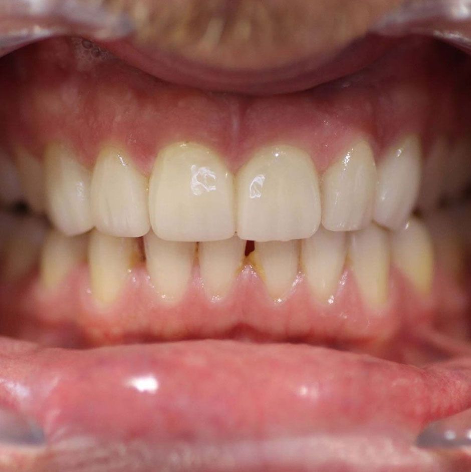 Porcelain Veneers - after