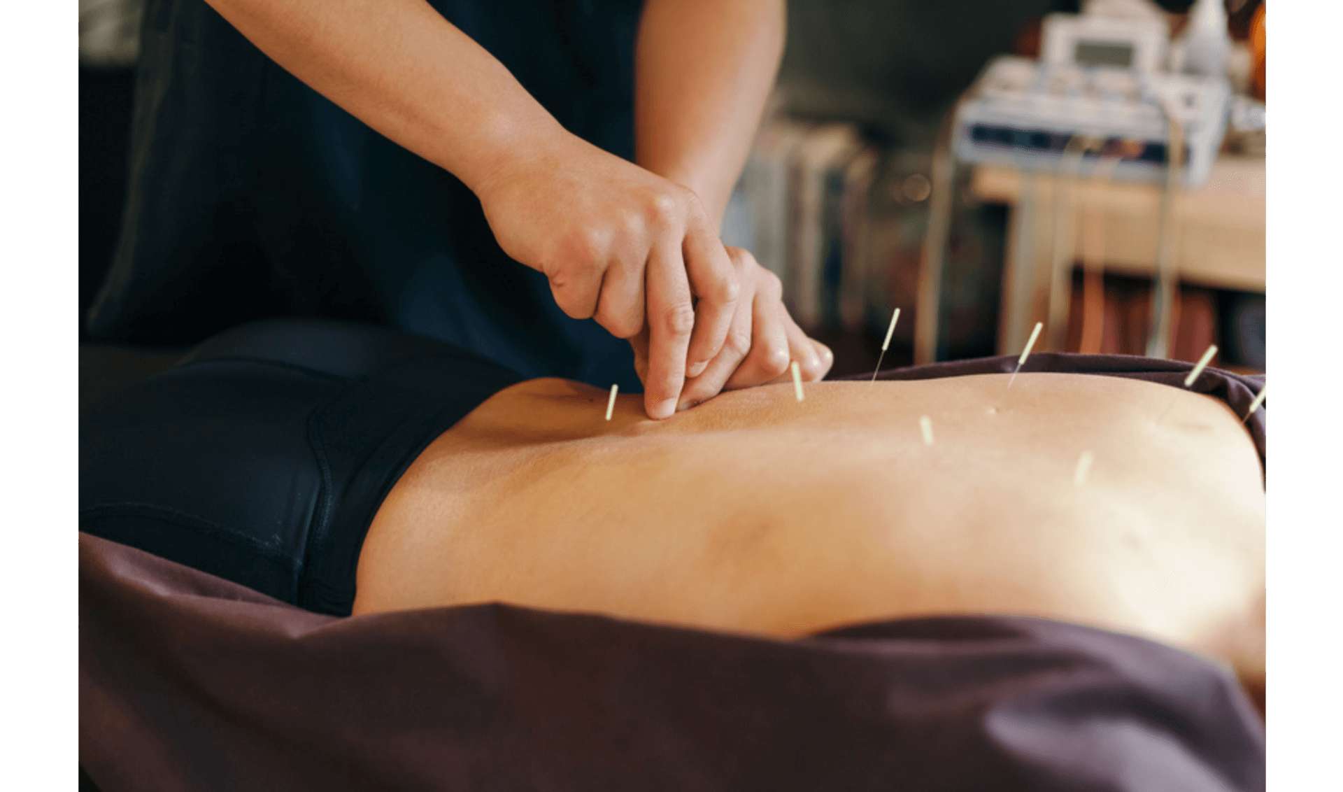 Practitioner performing acupuncture on a patient's bare back, inserting thin needles into the skin.