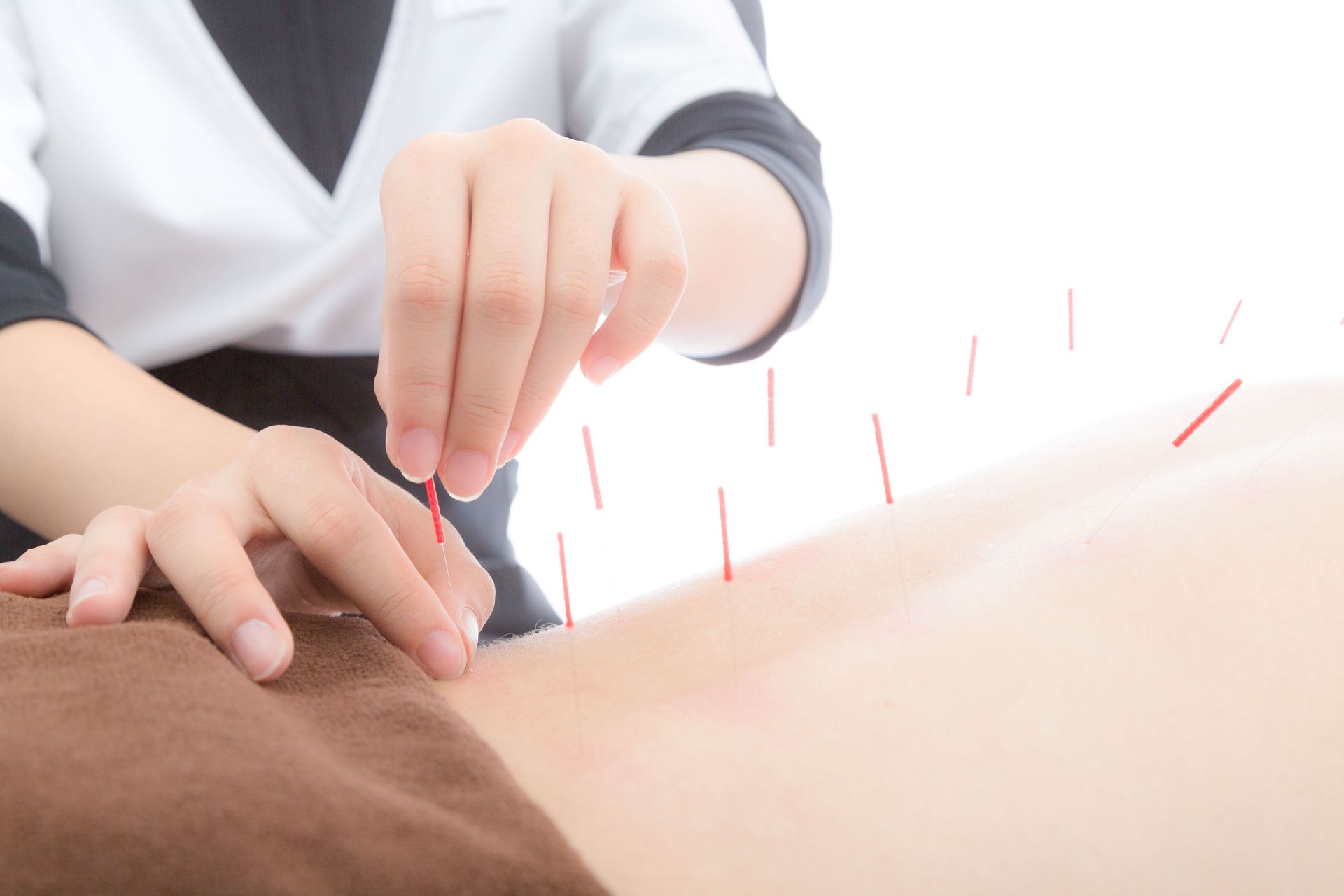 A practitioner performing acupuncture on a person's back, inserting thin needles into the skin.