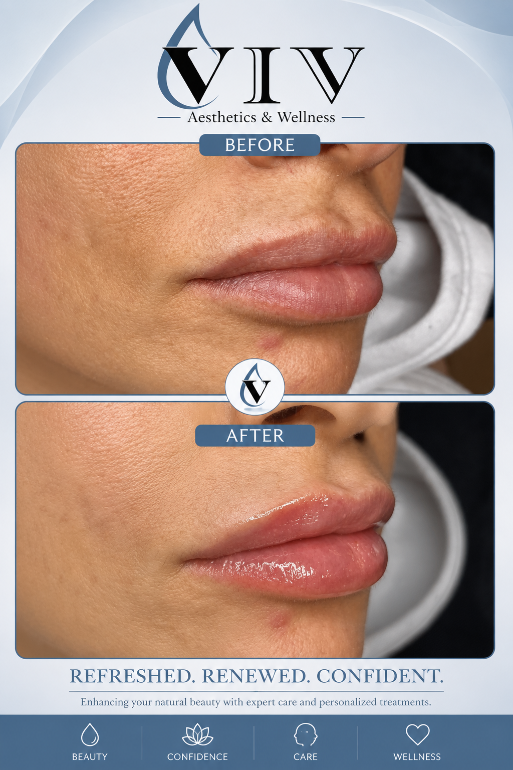 Before and after picture of lips