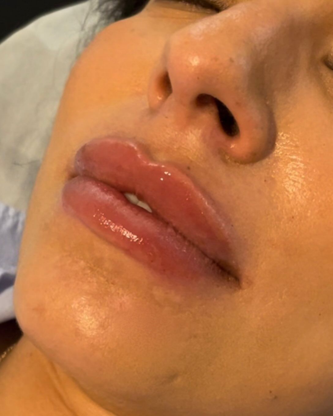 Close-up view of lips with a glossy, hydrated appearance after a cosmetic procedure.