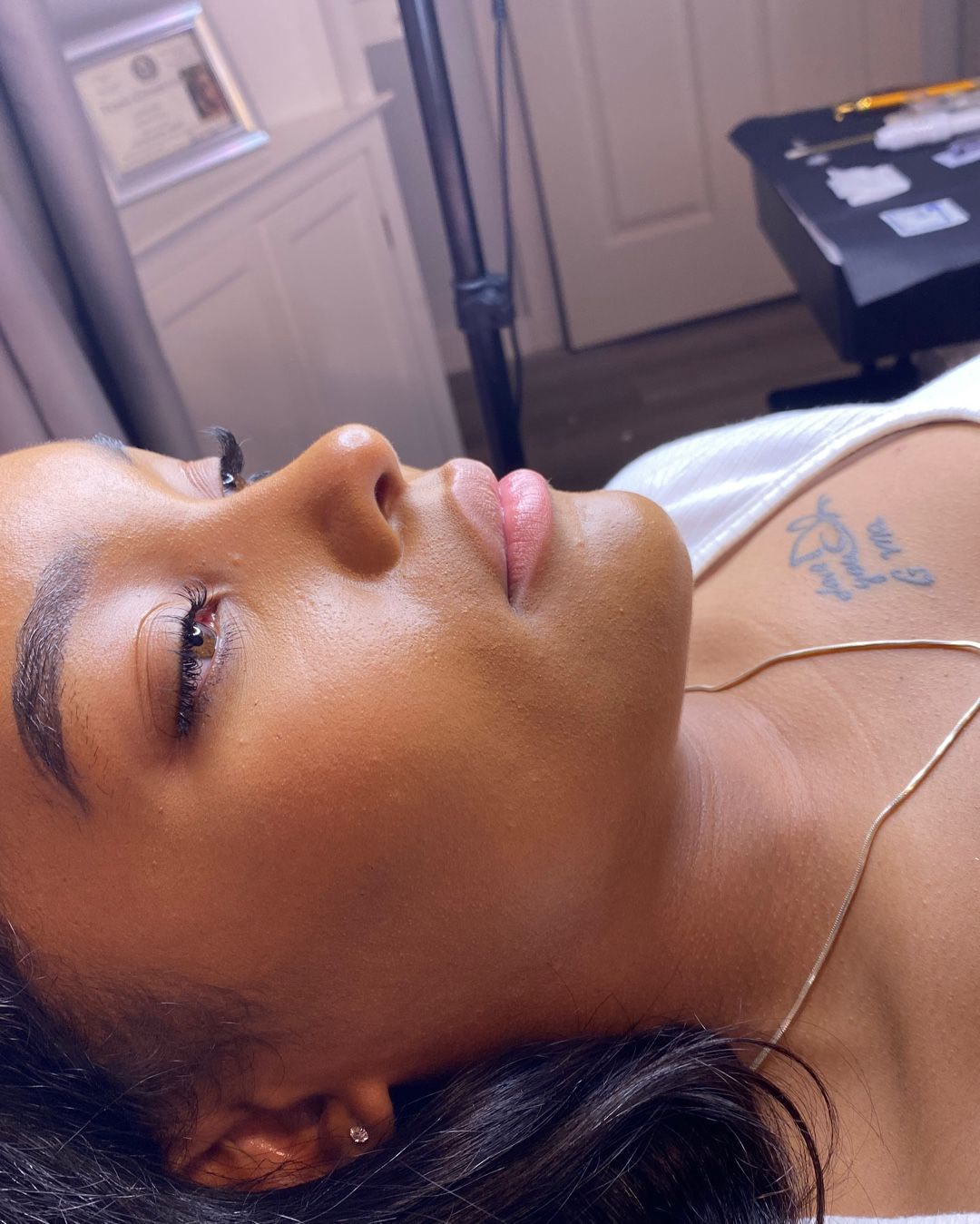 Side profile of a person lying down with closed eyes, showing a lip filler procedure in a clinical setting.
