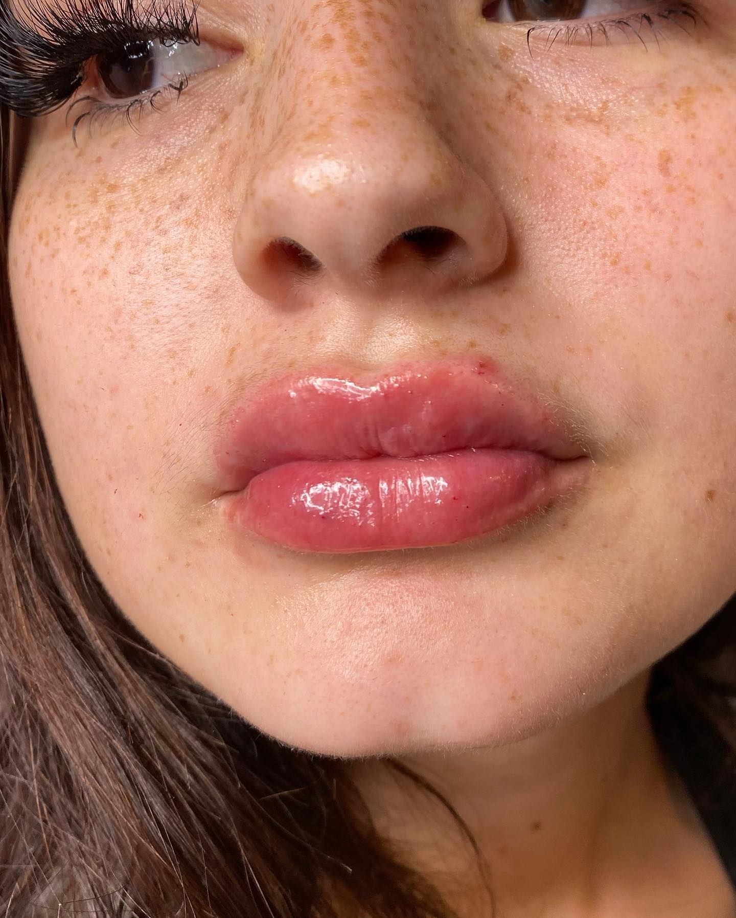 Close-up of a person's mouth and nose with swollen, red lips.