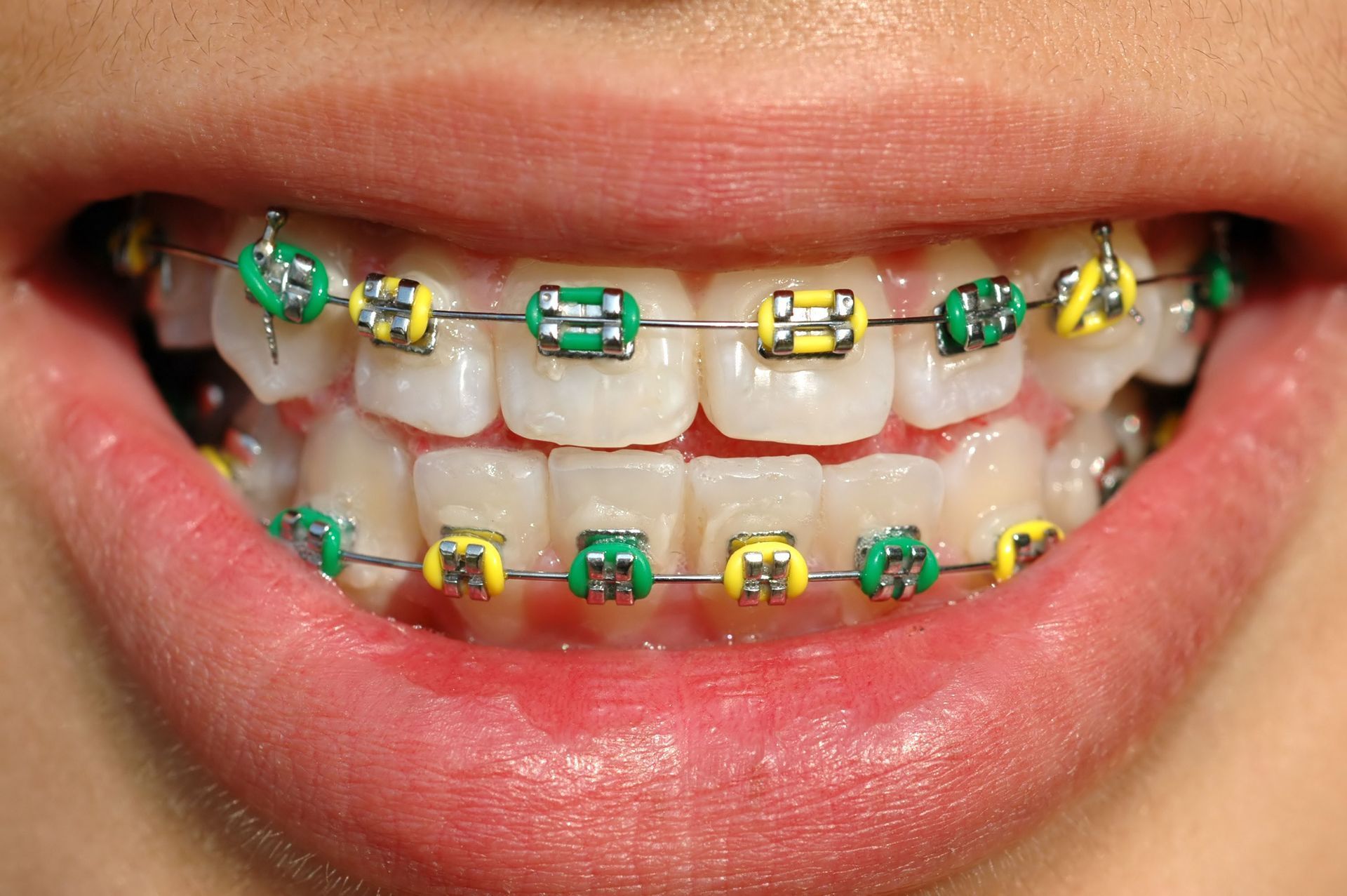 braces
