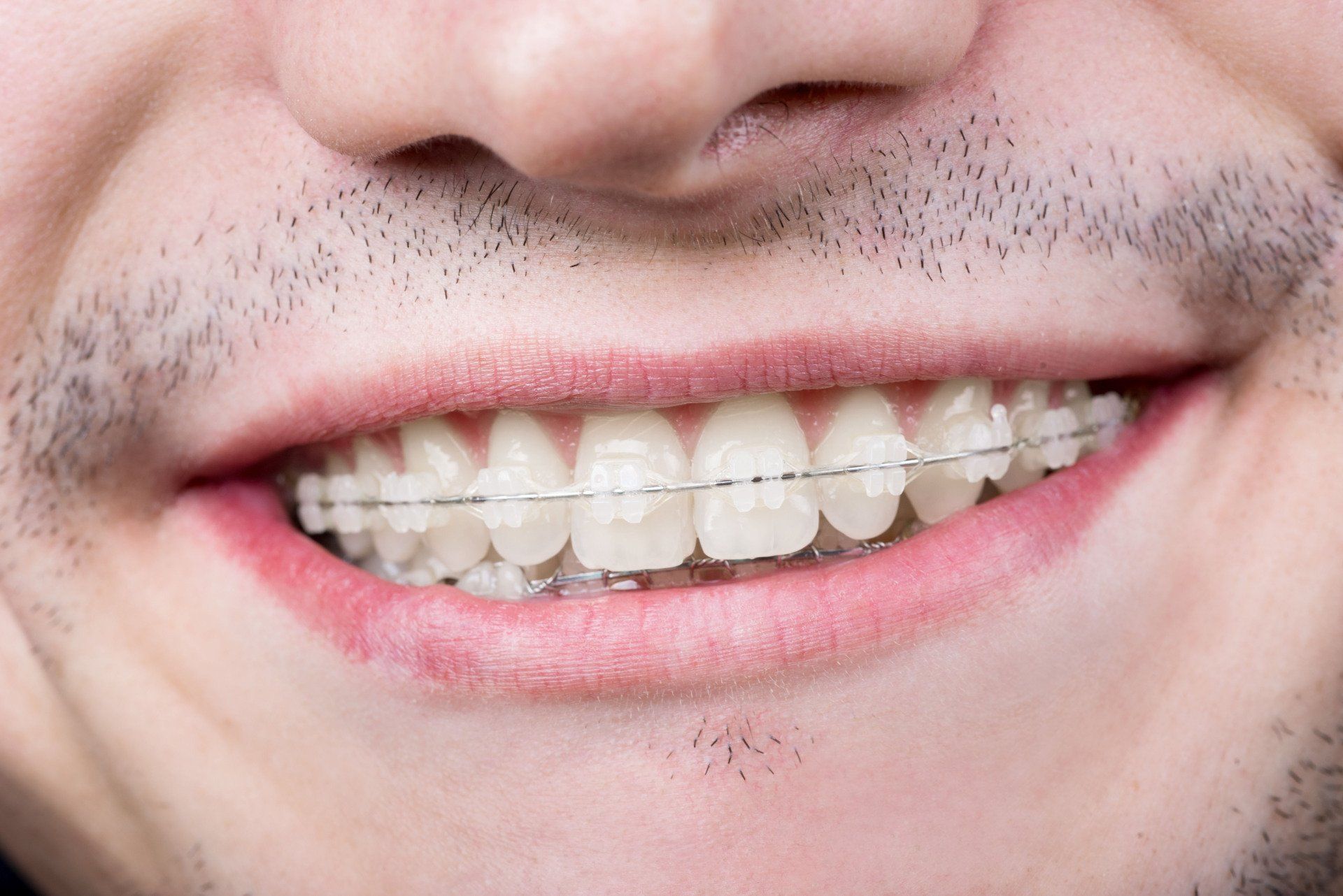 Close-up of a person smiling, showing teeth with clear braces.