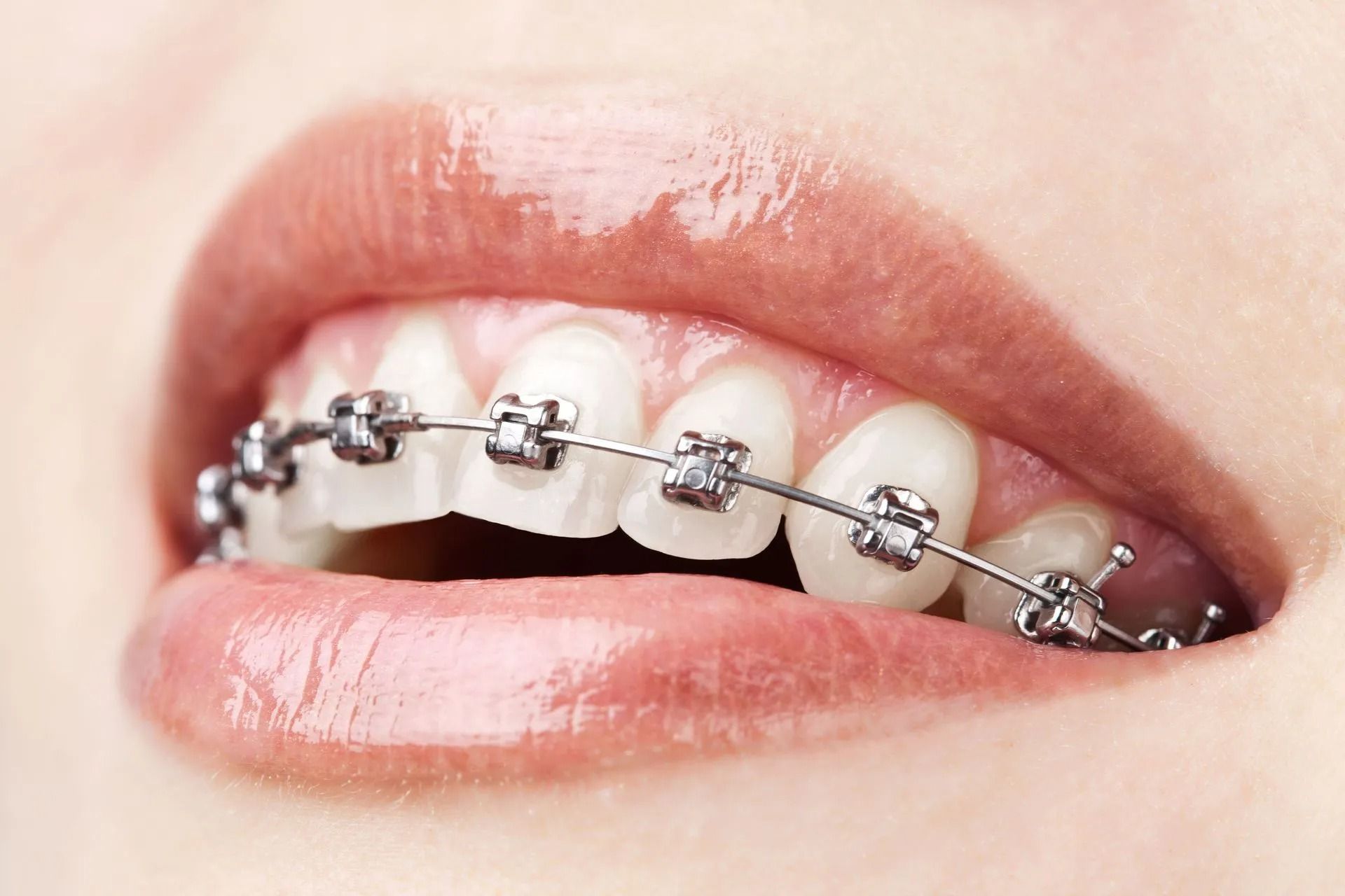 Mouth with metal braces; teeth are visible.