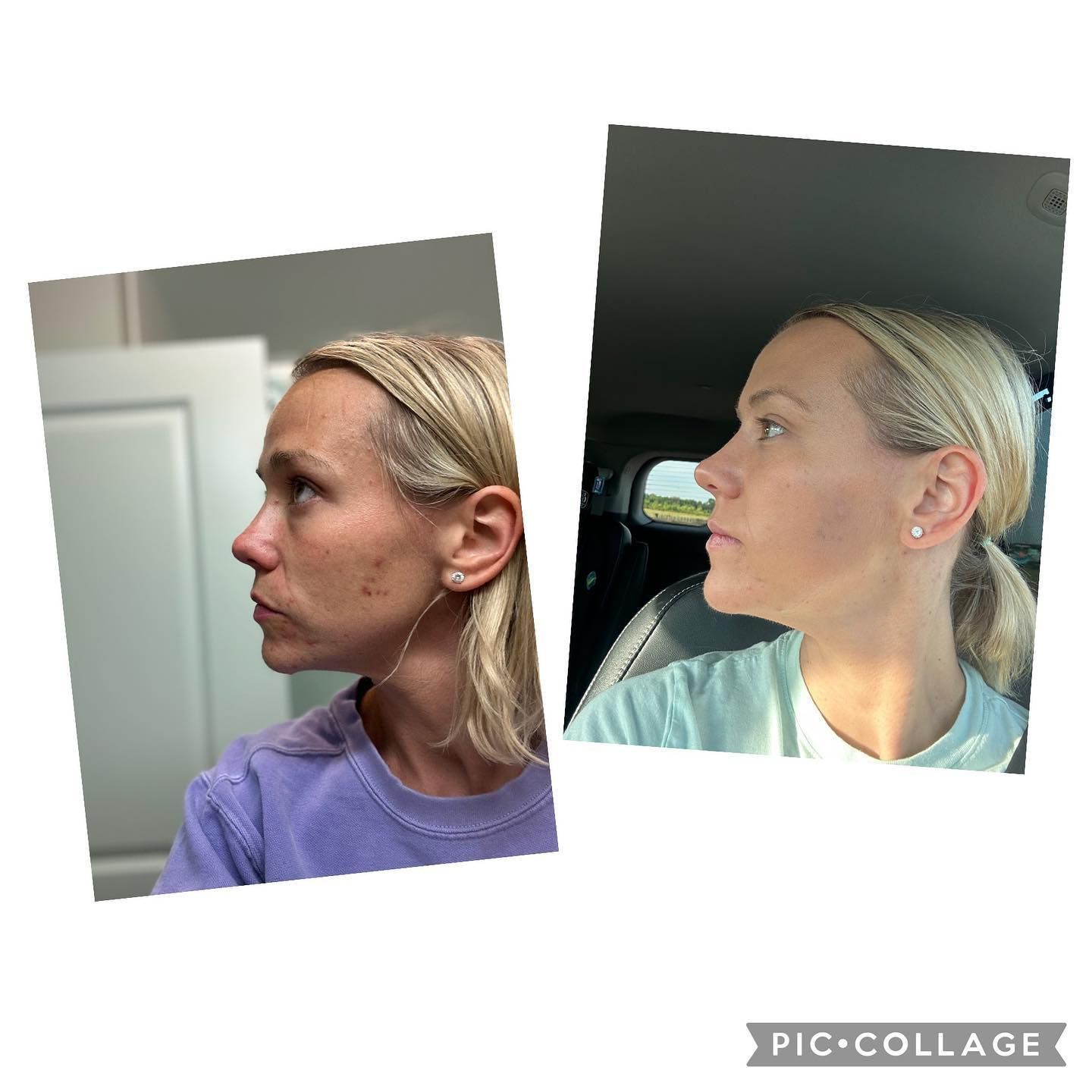 before and after treatment