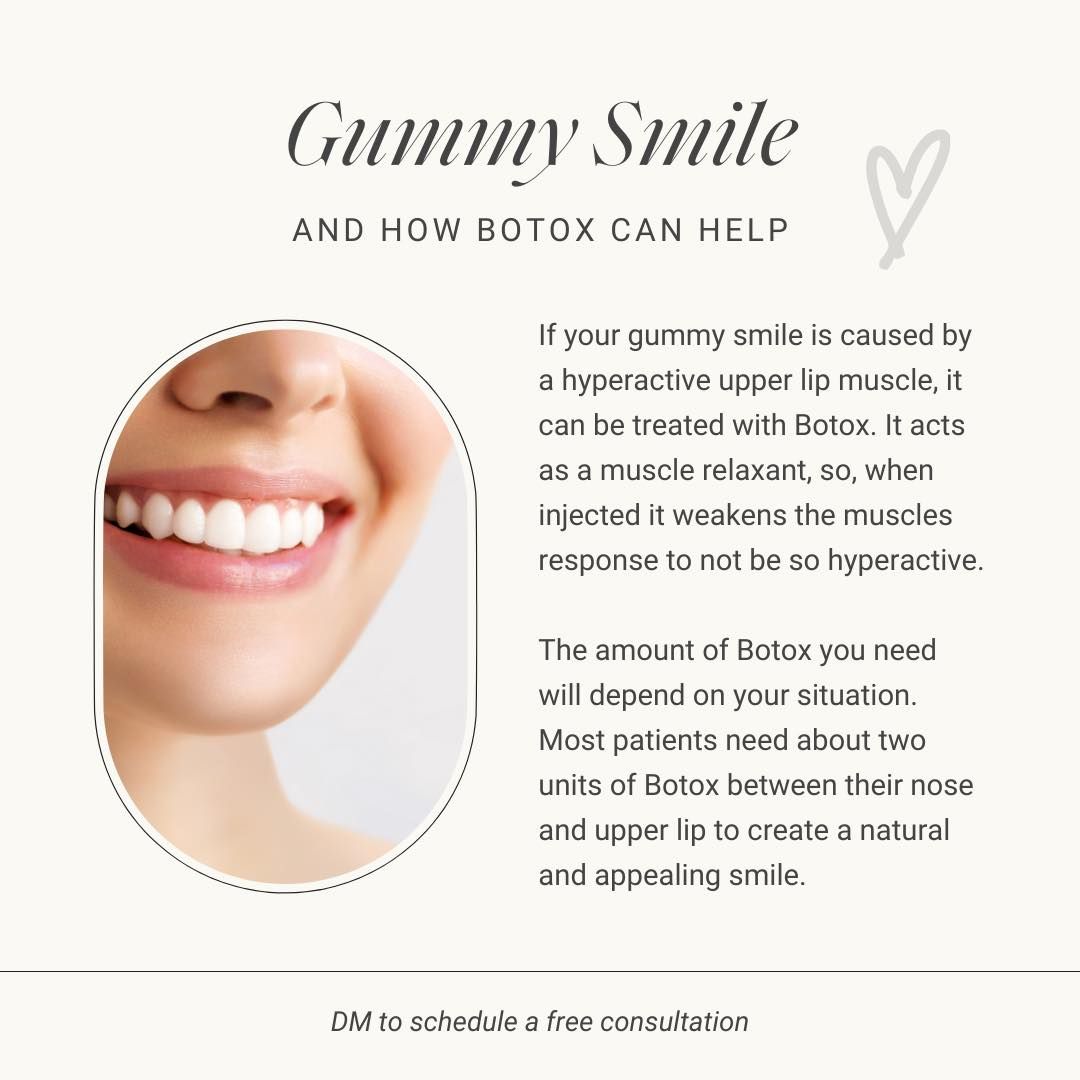 Gummy Smile and how Botox can help