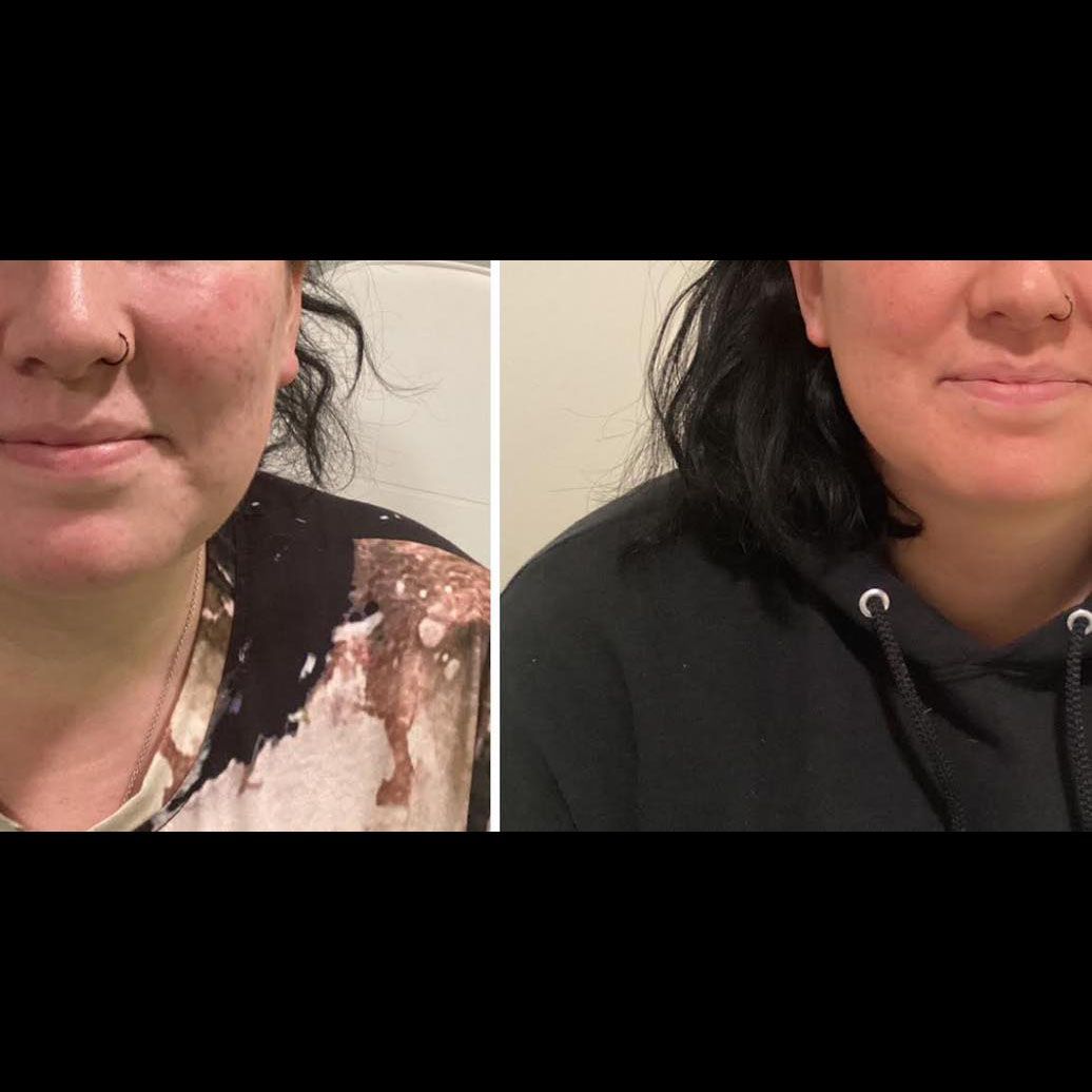 before and after a procedure