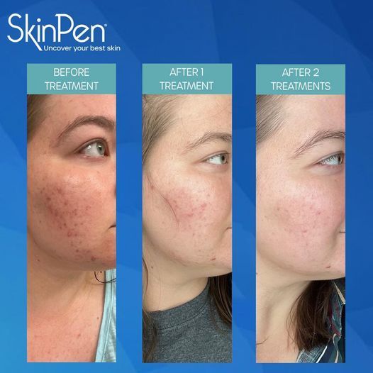 A woman 's face is shown before and after a skinpen treatment
