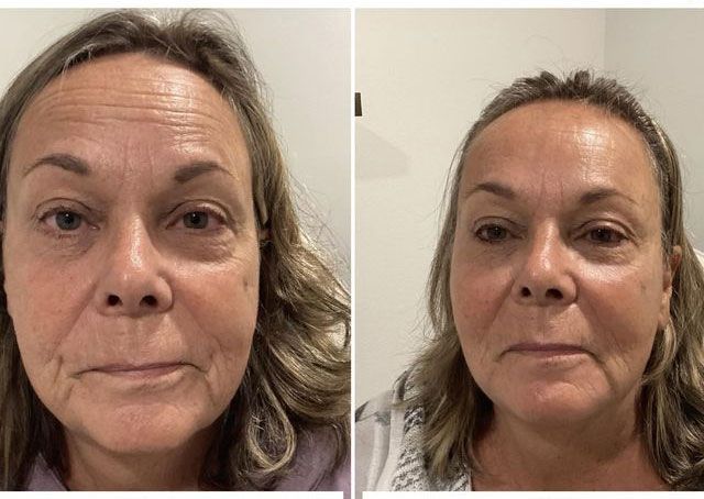 A before and after photo of a woman 's face.