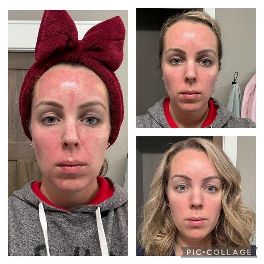 A before and after picture of a woman's face.