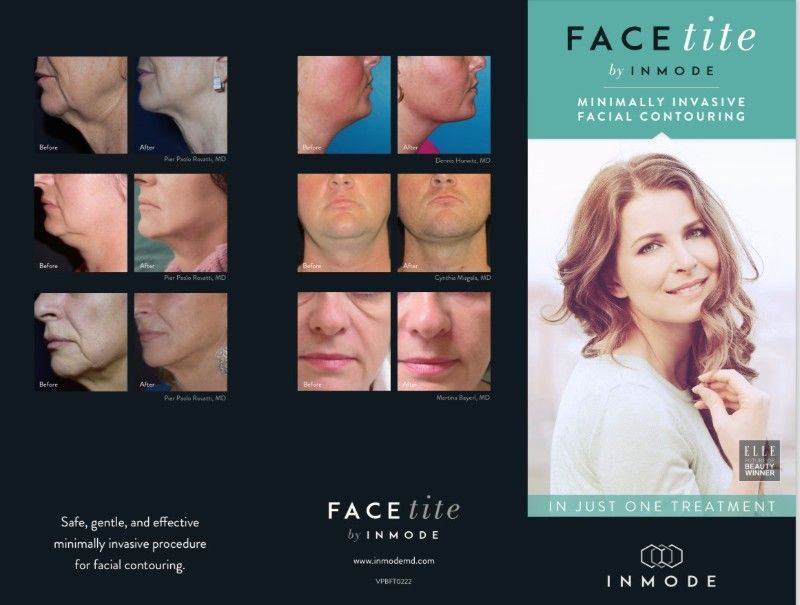 Before and after photos of FaceTite procedure. Shows facial contouring results on various patients, with a woman on the right.
