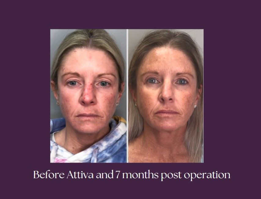 Visual transformation of the ATTIVA product, before and after.