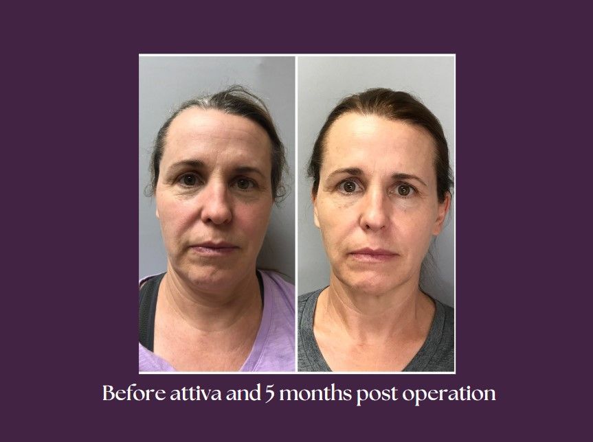 Before and after image showing a client’s face treated with ATTIVA.