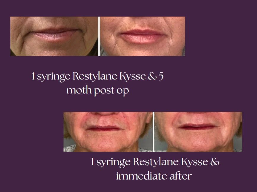 A before and after picture of the clients lips after using the product.