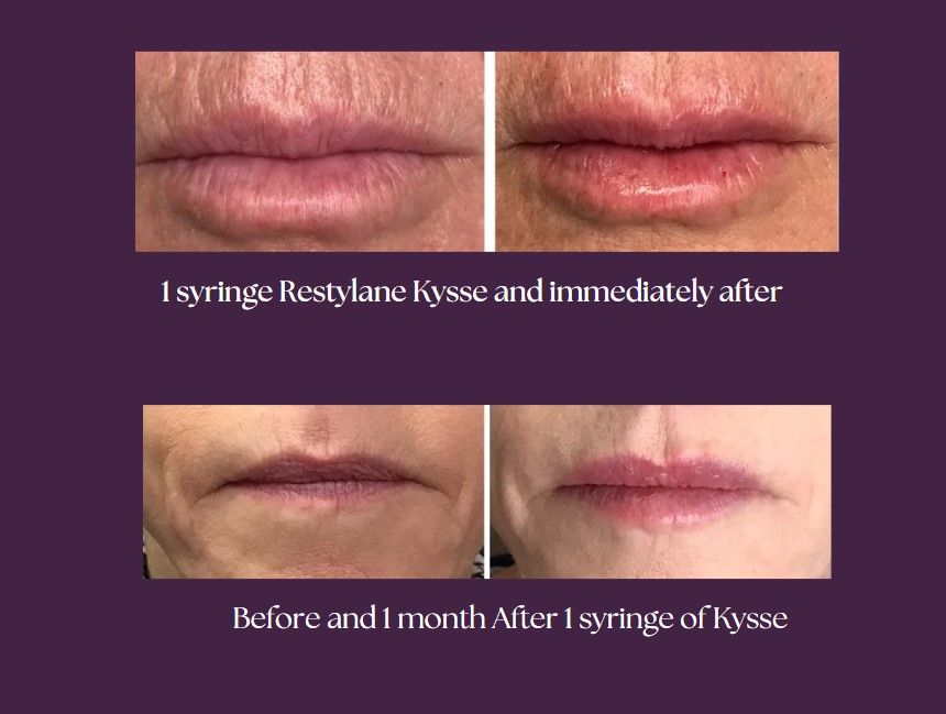 A before and after picture of the clients lips after injecting the product.