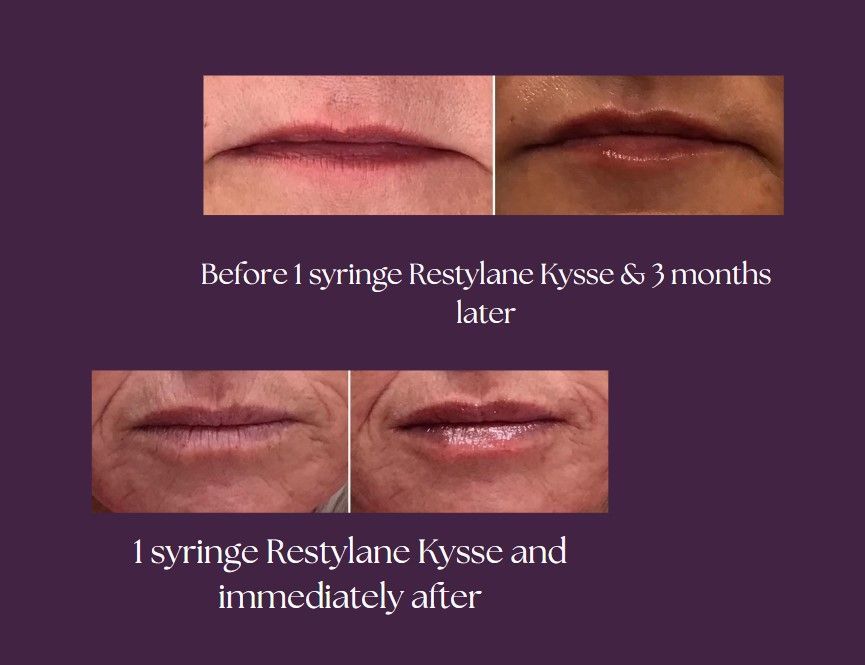 A before and after picture of the clients lips after using our product.