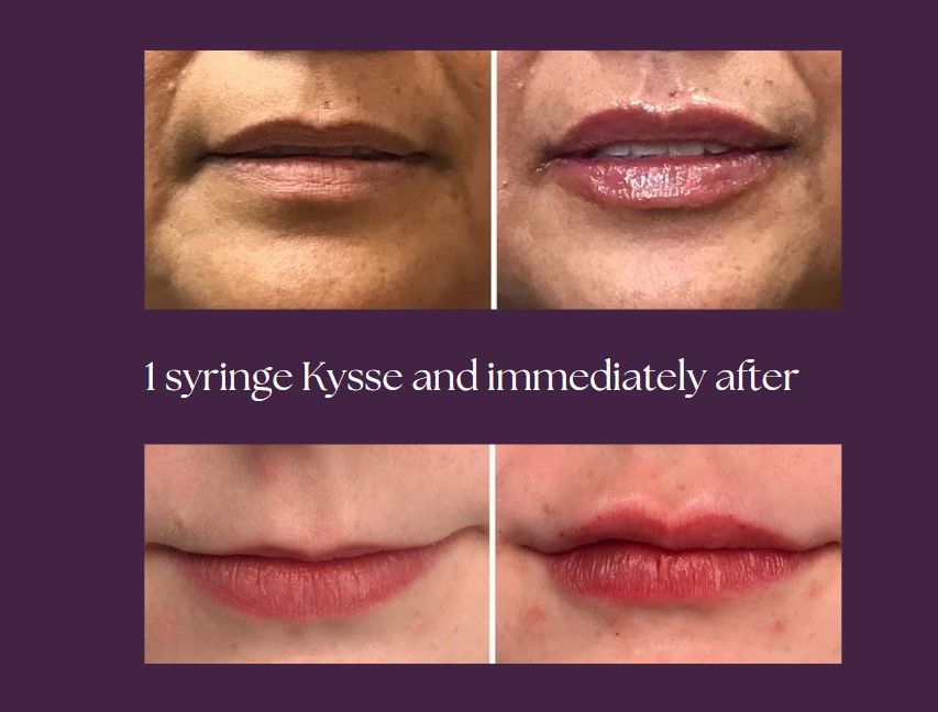 A before and after picture of the clients plump lips.