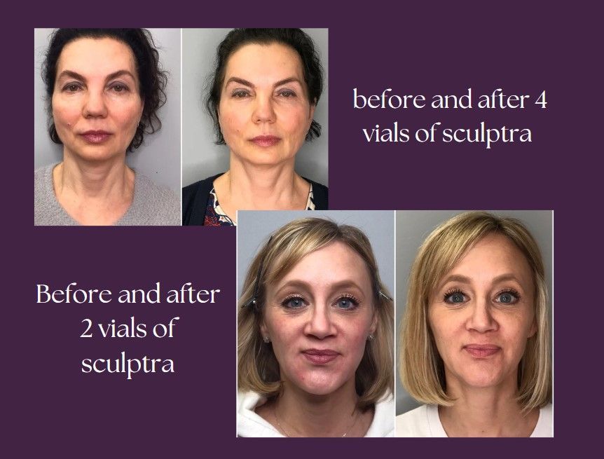 A before and after photo of a woman 's face after the product.