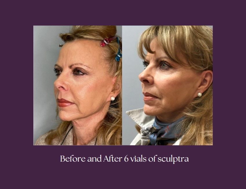 A before and after using the injectabls product.