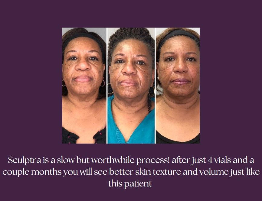 A before and after using our injectables product.