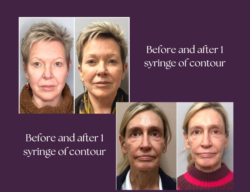 A before and after pictures of the woman.