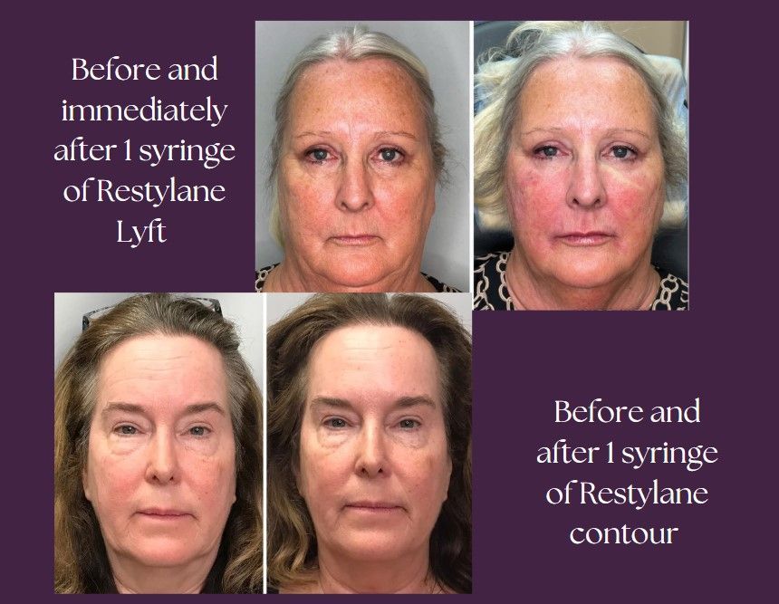 A before and after pictures of the client.