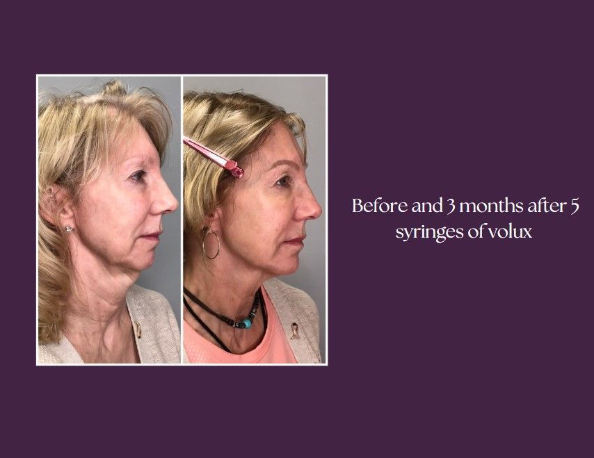 A before and after side view of the woman.